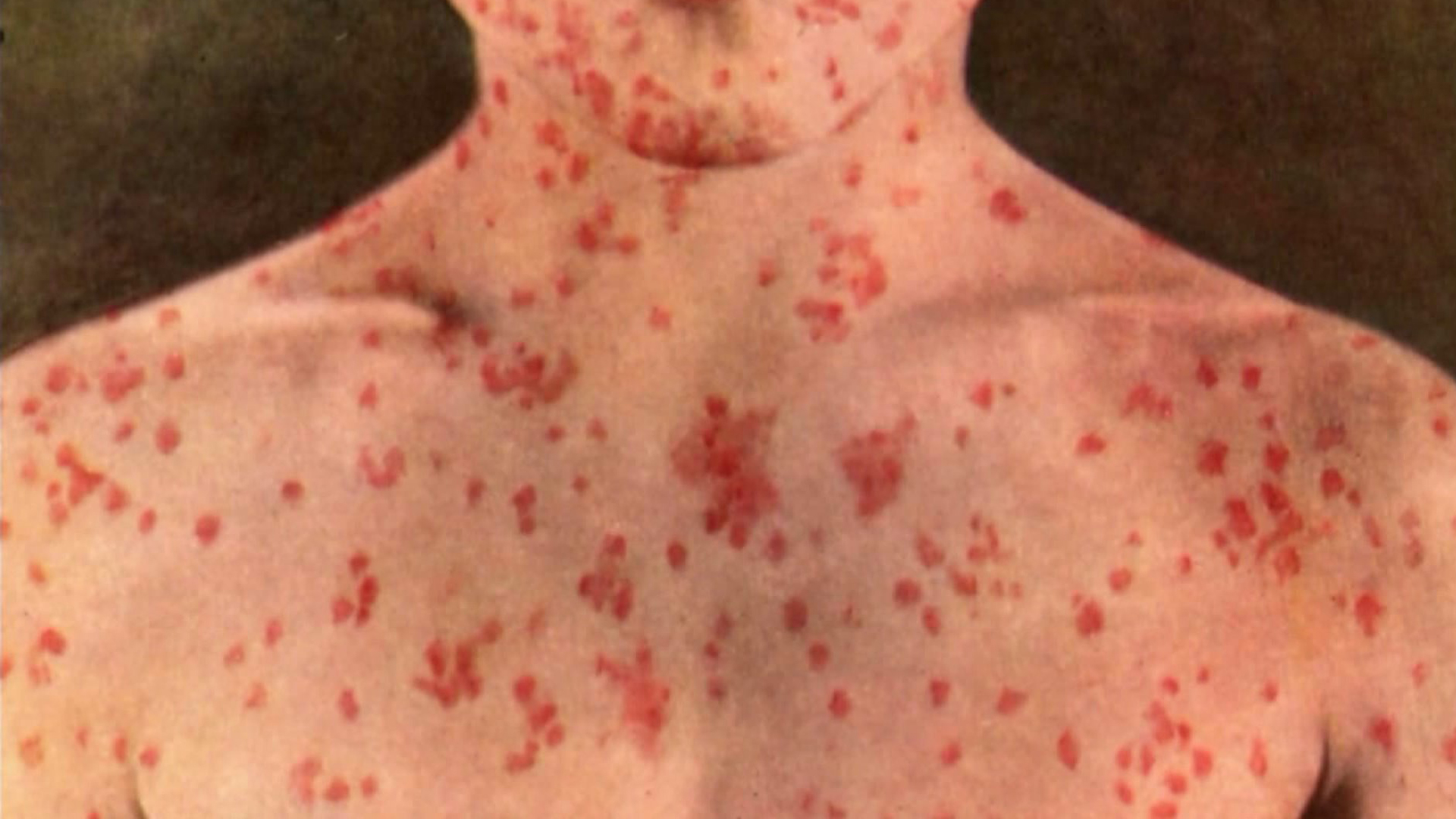 American Woman Dies…of Measles!