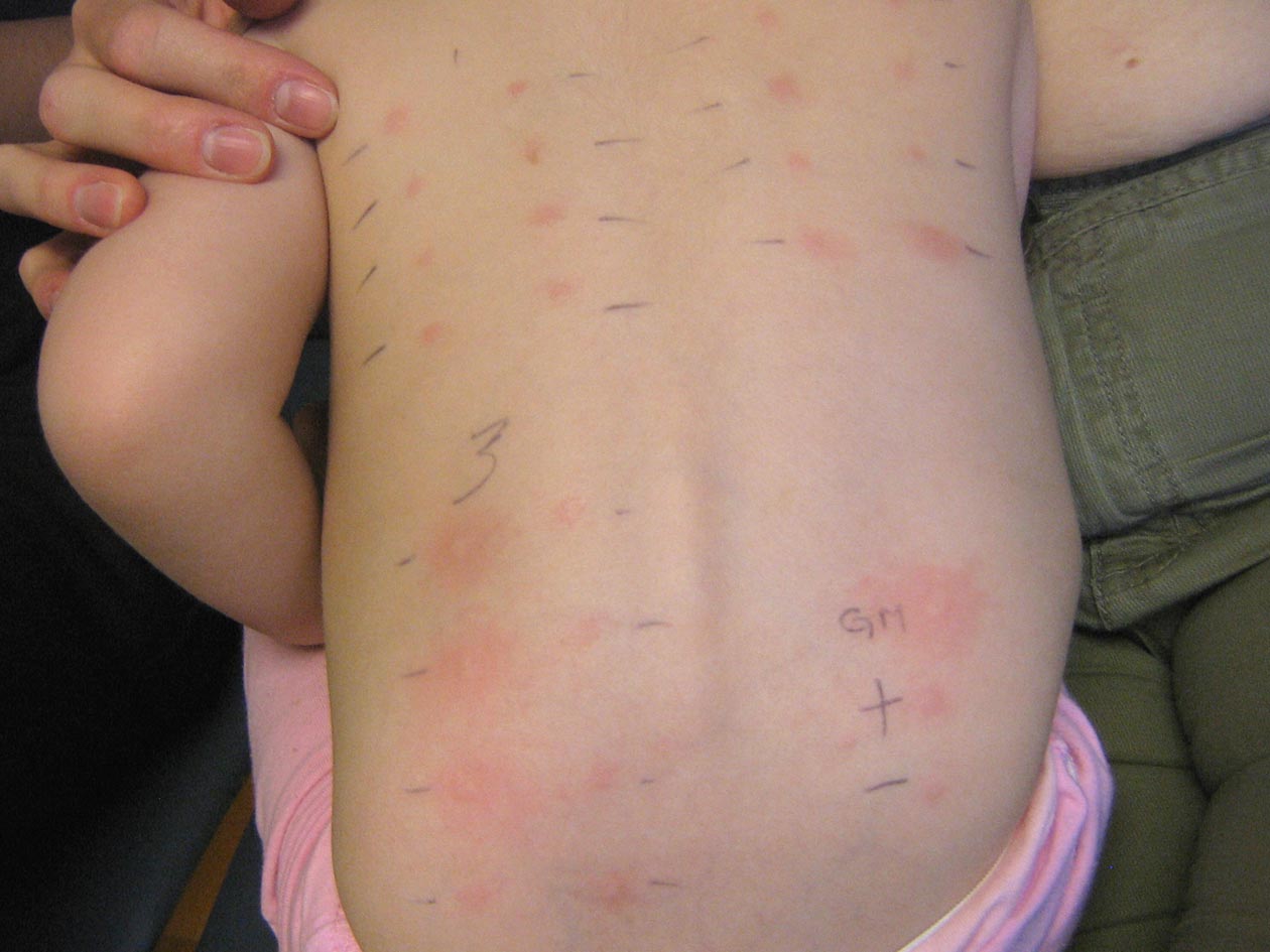Food Allergy Tests Notoriously Inaccurate