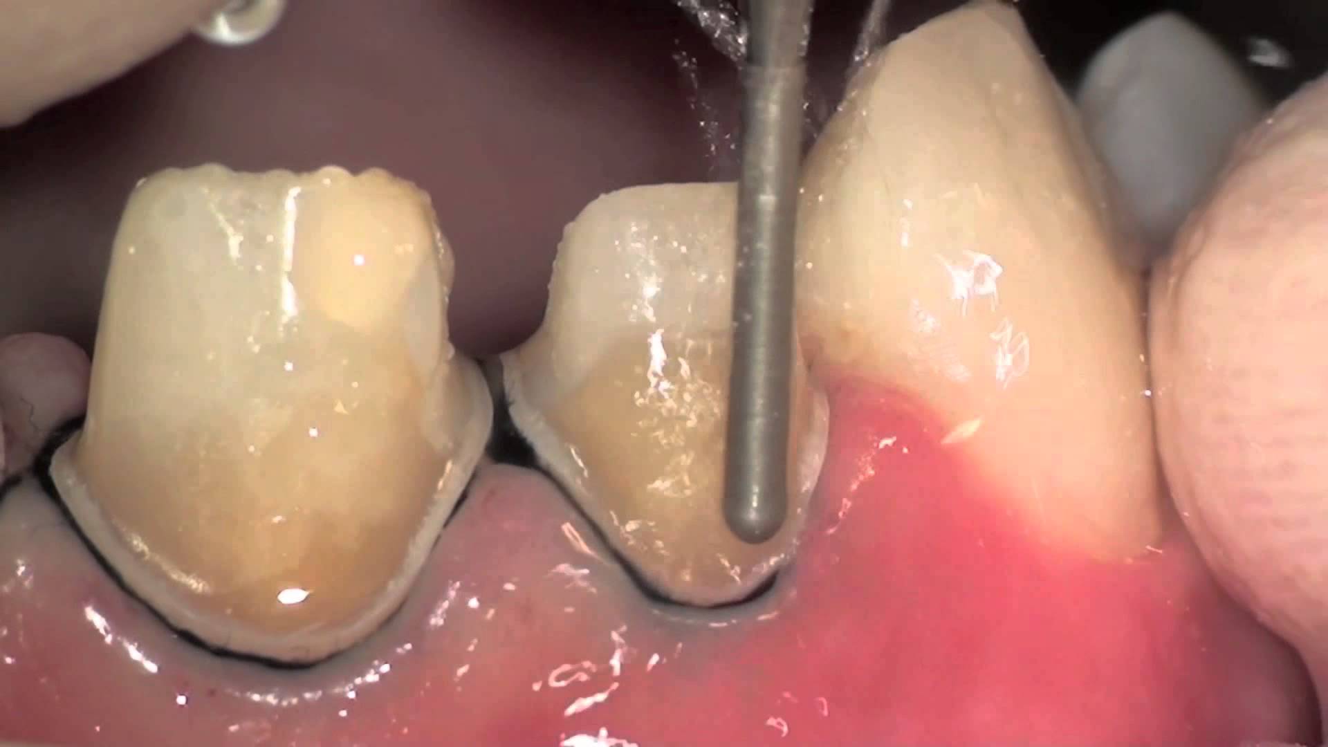 The Shocking Health Dangers of Root Canals
