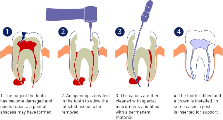 Are Root Canals Bad for Your Health?