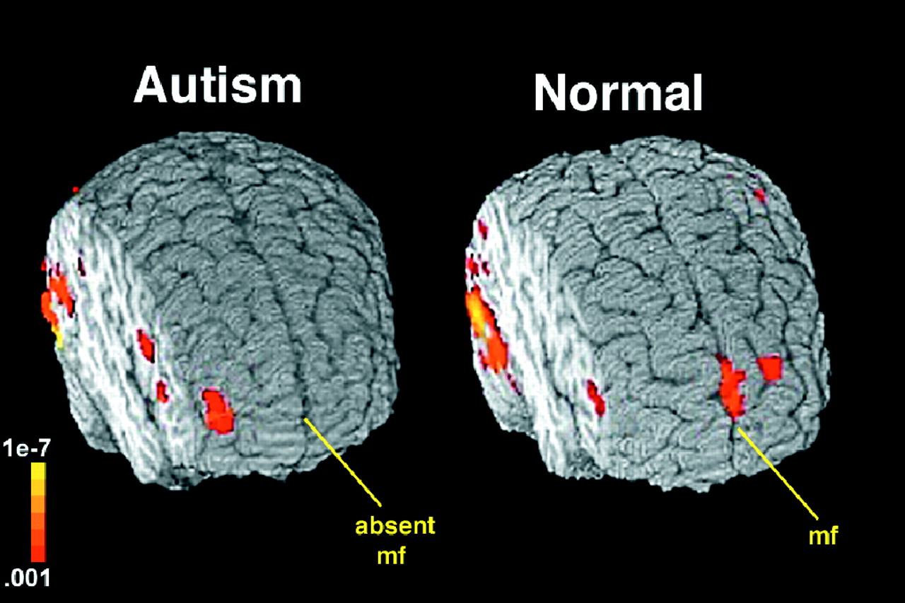 Worries Grow With Increasing Autism Diagnoses