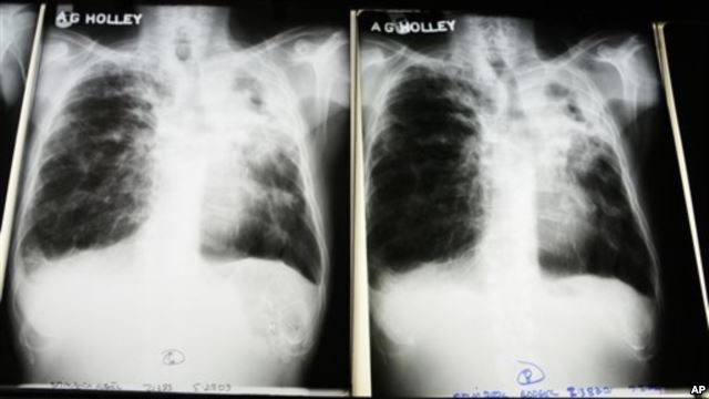 State Admits TB Cases Came From Immigrants, Refugees